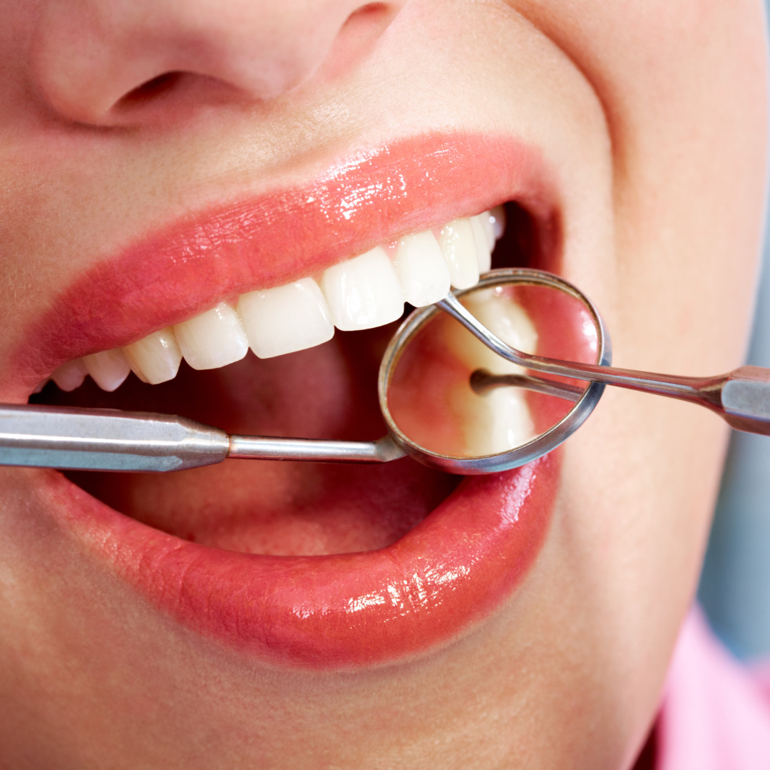 Dental Fillings in Omaha